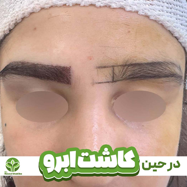 مراحل کاشت ابرو در تهران - دکتر رسول شکیبا