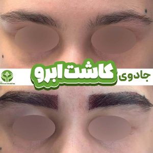 کاشت ابرو در تهران - دکتر رسول شکیبا