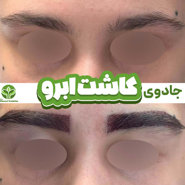 کاشت ابرو در تهران - دکتر رسول شکیبا