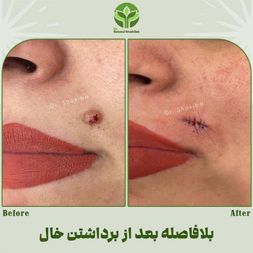 برداشتن-خال-01