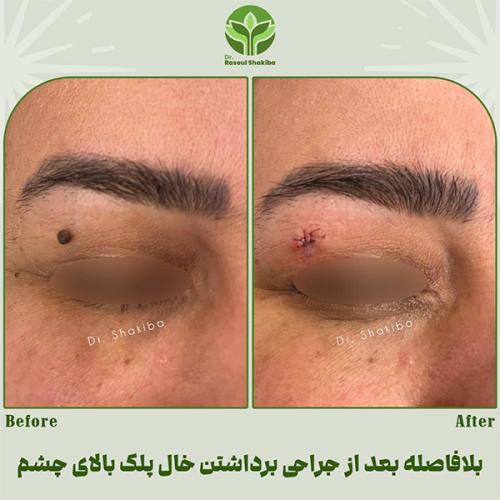 برداشتن-خال-02
