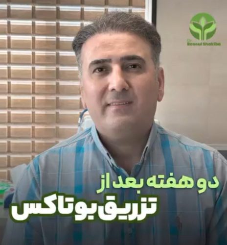 تزریق-بوتاکس-07