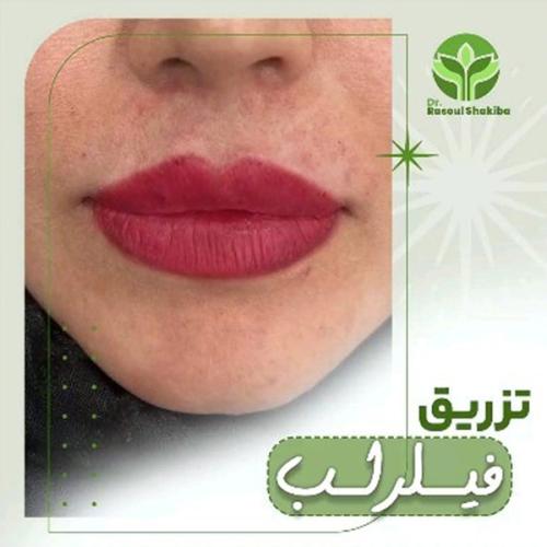 تزریق-فیلر-01