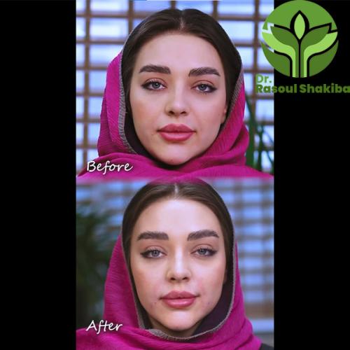 تزریق-فیلر-02