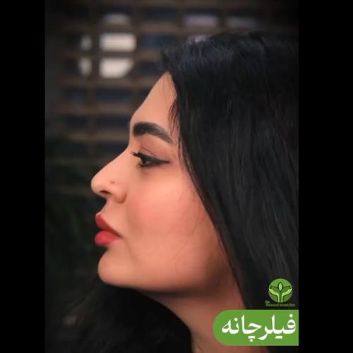 تزریق-فیلر-03
