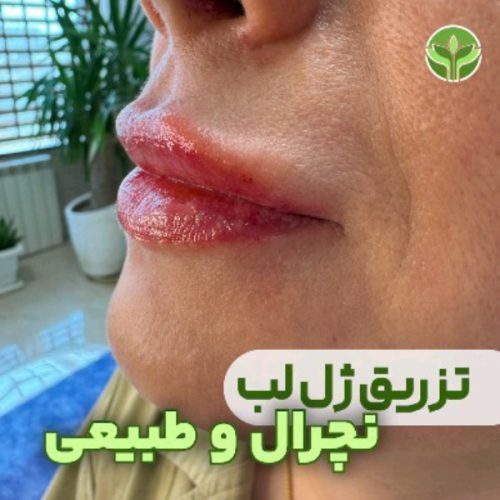 تزریق-فیلر-05