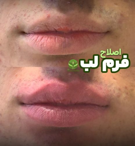 تزریق-فیلر-06
