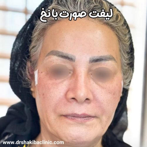 لیفت-نخ-02