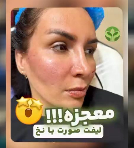 لیفت-نخ-03